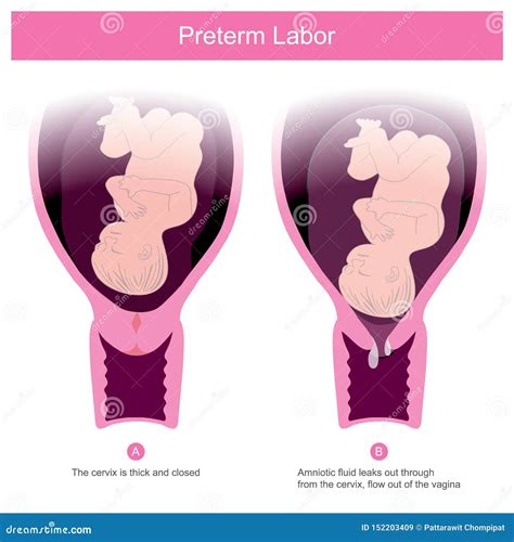 The Premature Birth, Can Occur in Conditions of Amniotic Fluid Leaks Out through the Cervix .and ...
