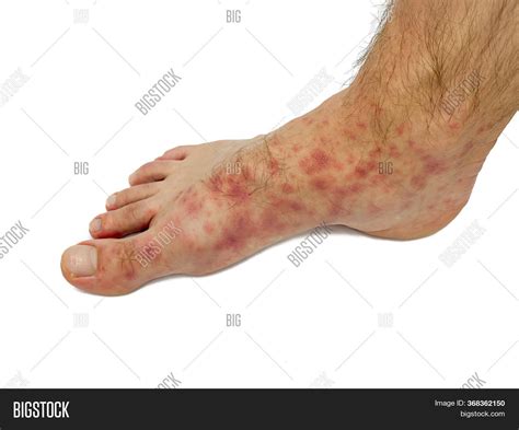 Red Rash On Feet Male Image & Photo (Free Trial) | Bigstock