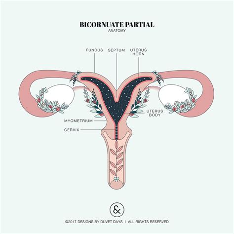 The bicornuate uterus has two uterus horns that are separated by the ...