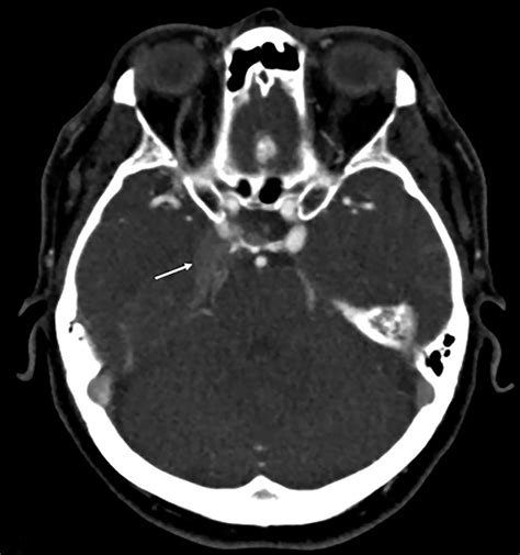 Dural Arteriovenous Fistula | Applied Radiology