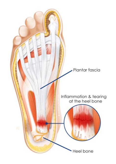 Plantar Fasciitis 的图像结果
