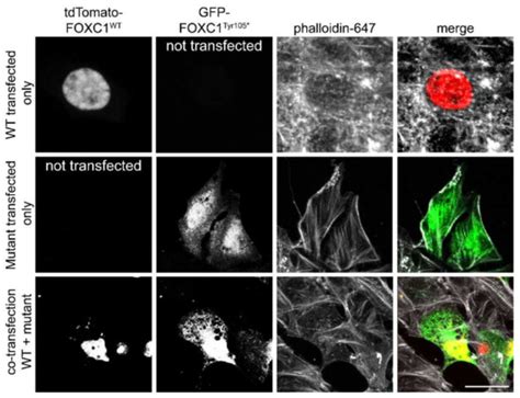 Variable Anterior Segment Dysgenesis and Cardiac Anomalies Caused by a ...