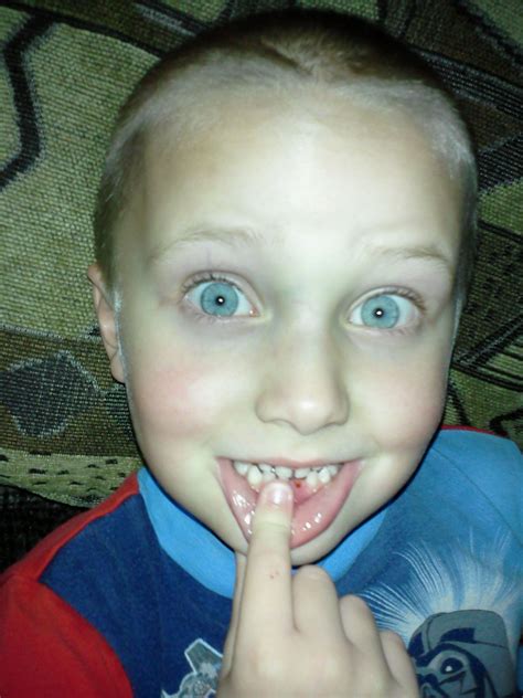 Image result for Lost Tooth