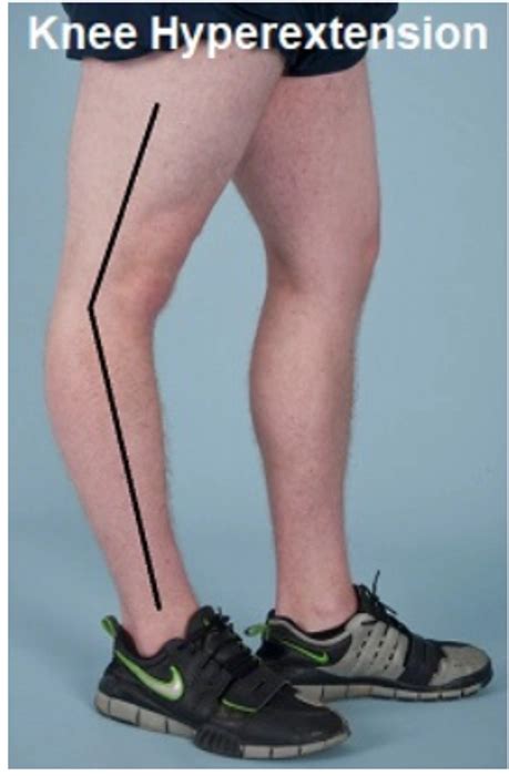 Hyperextension Knee Solutions at Dhyan Health Care