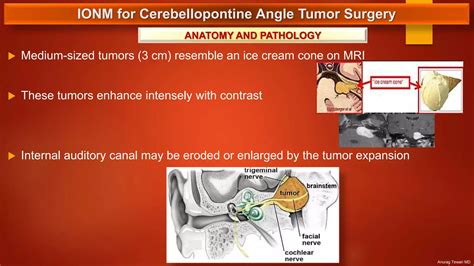 IONM for Cerebellopontine Angle Tumor Surgery | PPTX