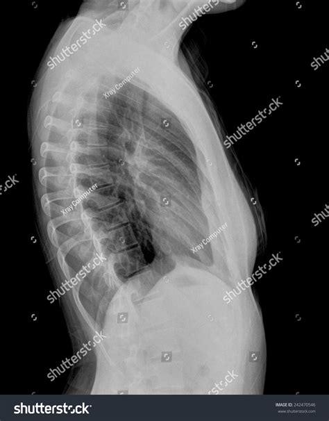 Lateral Chest X Ray Labeled/2 View Chest X Ray