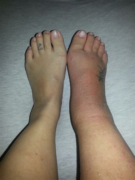 My Broken Ankle =(: Day 4 - Very swollen and red