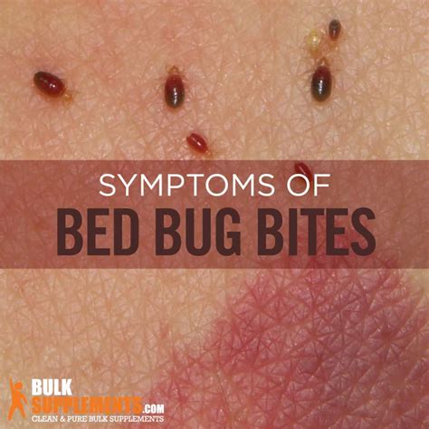 Bedbug Bite: Characteristics, Causes & Treatment | BulkSupplements.com