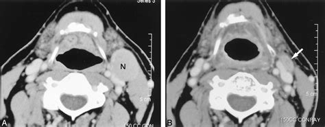 Kuvatulokset haulle pericolonic lymph nodes