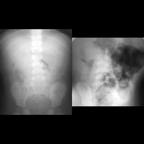 Infant with 2 days of bilious emesis | Pediatric Radiology Case | Pediatric Imaging ...