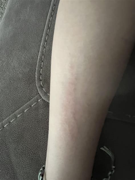 Red and Purple dots that itch then turn into a rash and then bruise ...