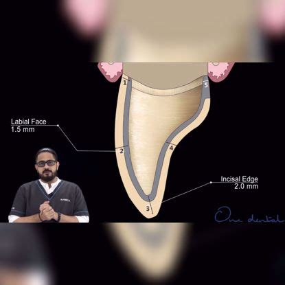 Detailed demonstration of tooth preparation of an incisor for full ...