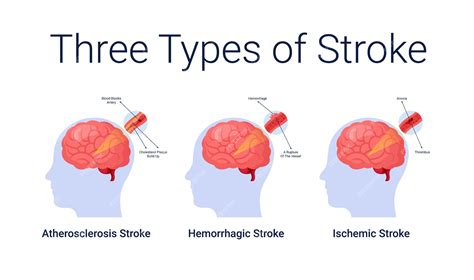 Ischemic stroke diseases stage anatomy diagram vector illustration | Premium Vector