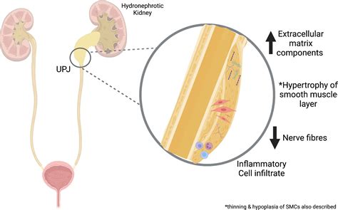 Ureteropelvic Junction Stone Vesicoureteral Reflux (VUR): Causes,