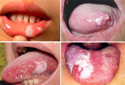 舌头白斑是什么病图片