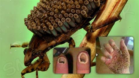 Fake images of holes in skin to terrify people been viral for long. - SM Hoax Slayer Swachh ...