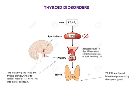 Image result for hyperthyroidism
