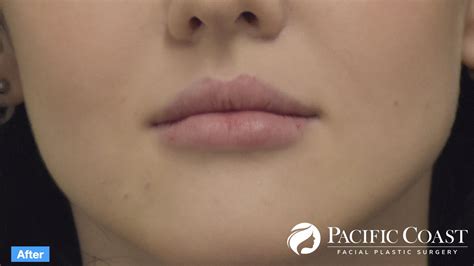 Lip Filler Before and After | Natural Results in Orange County