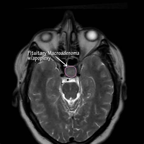 Neuroanatomy Glossary: Pituitary Adenoma (Macro vs Micro) | ditki ...