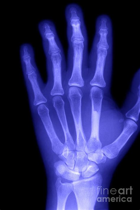 Image result for Normal Hand