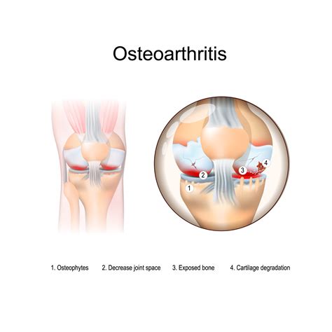 Degenerative Joint Disease (DJD) | Arthritis Knee Pain Centers