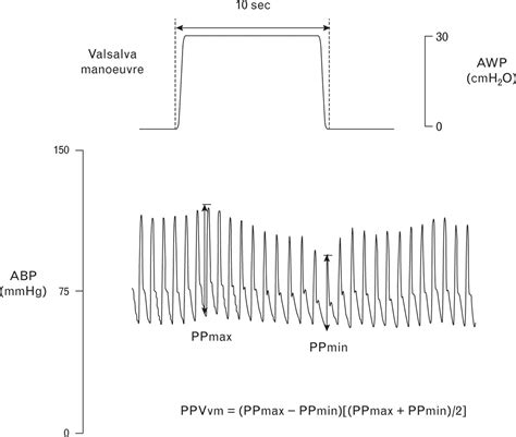 Image result for Pulse Pressure Variation Monitoring