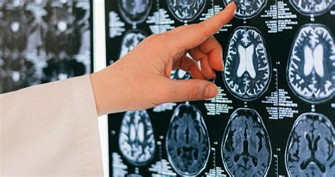 Znanstvenici otkrili da Alzheimerova bolest može preći s čovjeka na ...