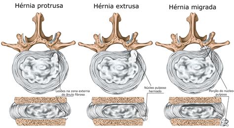 Tipos De Hernias De Disco - NAZAEDU