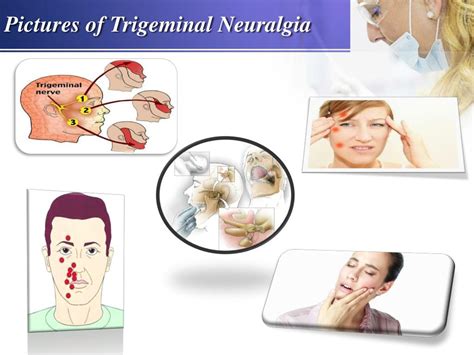 PPT - Trigeminal Neuralgia - Causes, Symptoms, Prevention and Treatment - Biogetica PowerPoint ...