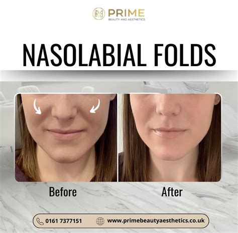 Nasolabial Fold FillerTreatment - Prime Beauty & Aesthetics - Manchester