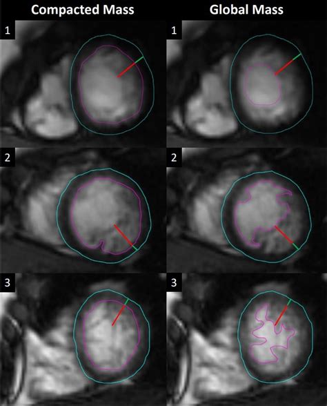 Differentiating Excessive Trabeculations FBom Left Ventricular Non-compaction Cardiomyopathy ...