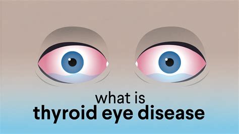 Eye Puffiness Thyroid