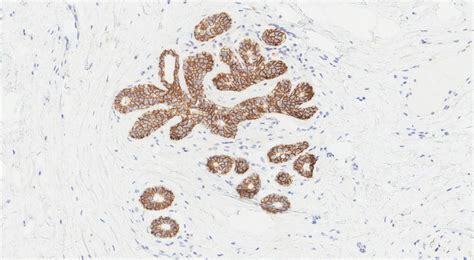 Your pathology report for atypical lobular hyperplasia of the breast | MyPathologyReport