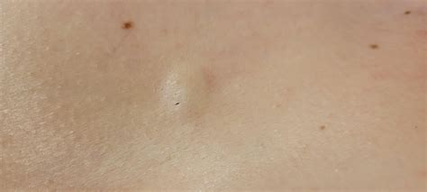 Lump On Chest Near Sternum