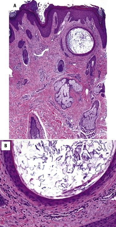 Epic Exploding Cysts 的图像结果