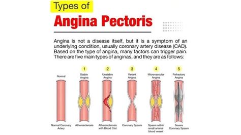 Angina Pectoris (Stable & Unstable) patient awareness