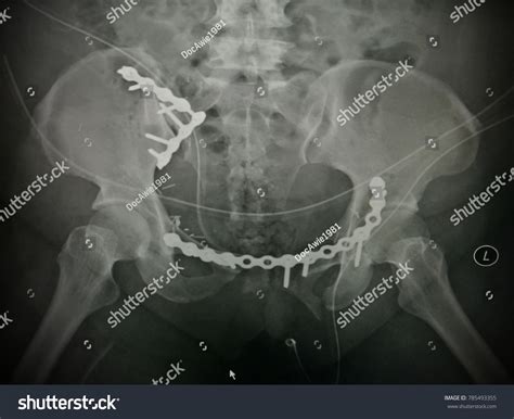 2,128 Pelvic fracture 이미지, 스톡 사진 및 벡터 | Shutterstock