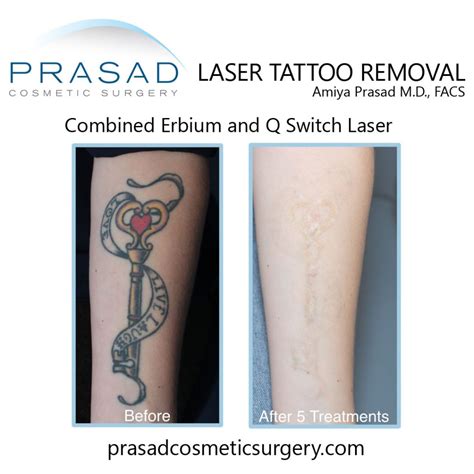 Does Tattoo Removal Hurt?