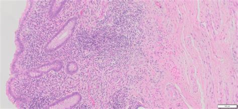 Image result for Normal Appendix Appearance