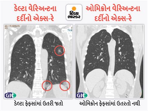First time look at omicron and delta variant X-ray comparison, delta ...