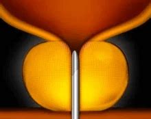 Image result for Problems After UroLift