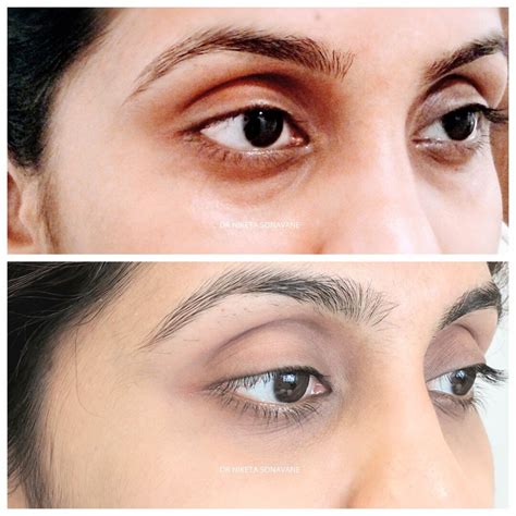 Dark Circle Removal in Mumbai - Laser Treatment, Filler, Peel Cost