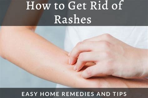 How to Get Rid of Rashes: Easy Home Remedies and Tips