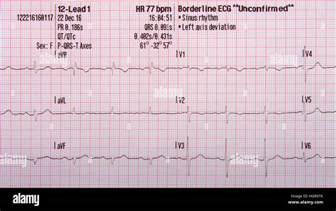 Normal ECG Read Out 的图像结果
