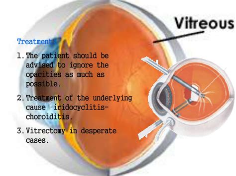 PPT - Vitreous Anatomy & Diseases: Understanding Symptoms, Causes, and Treatment Options ...