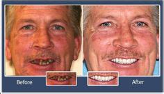 Image result for Angion Method Review