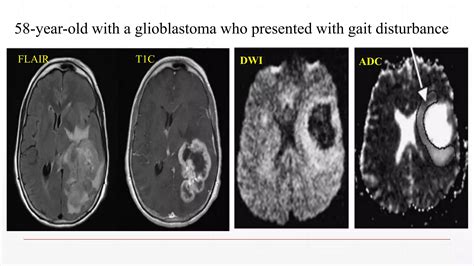 high grade glioma | PPTX