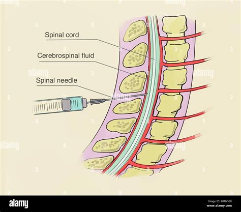 What Is Lumbar Puncture Lp at James Givan blog