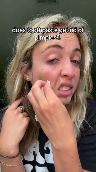 Image result for Does Toothpaste Help Pimples