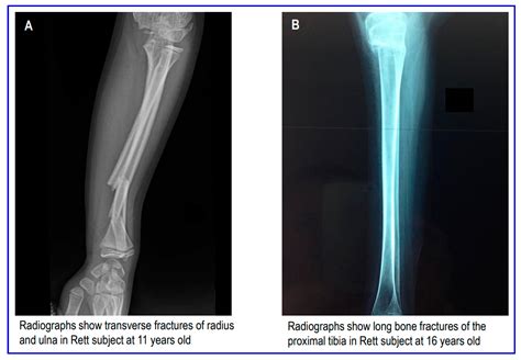 Bone Fracture in Rett Syndrome: Mechanisms and Prevention Strategies